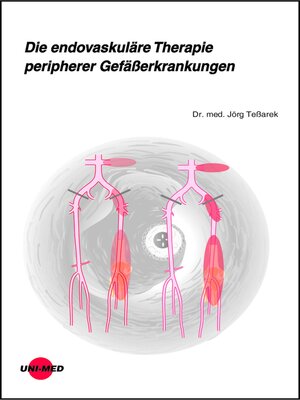cover image of Die endovaskuläre Therapie peripherer Gefäßerkrankungen